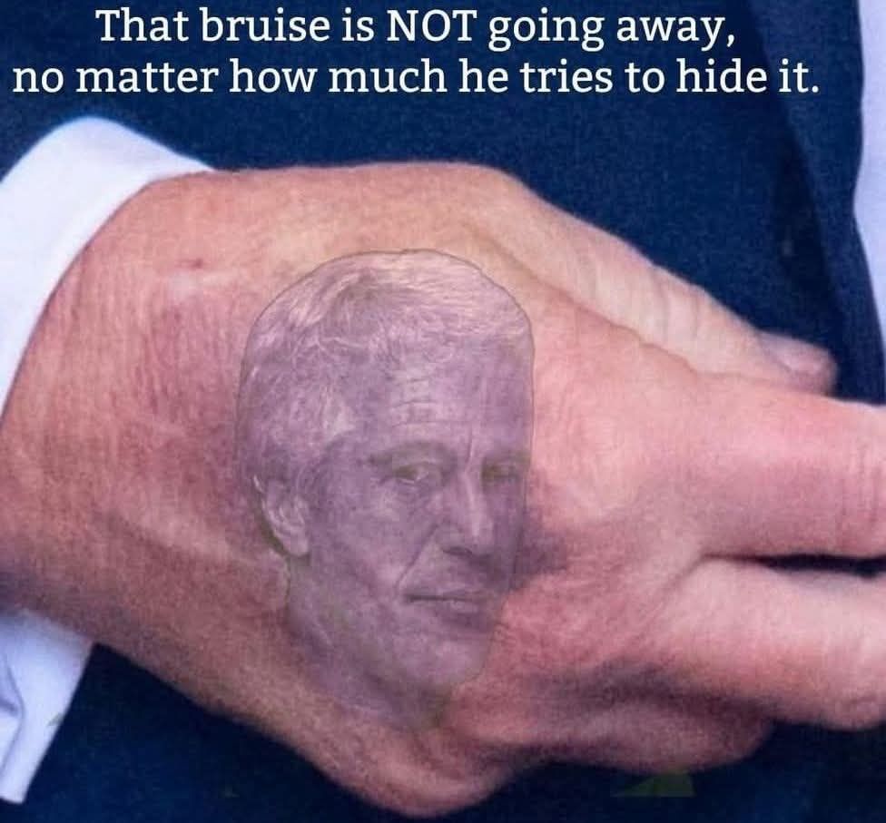 bruise-is-not-going-away