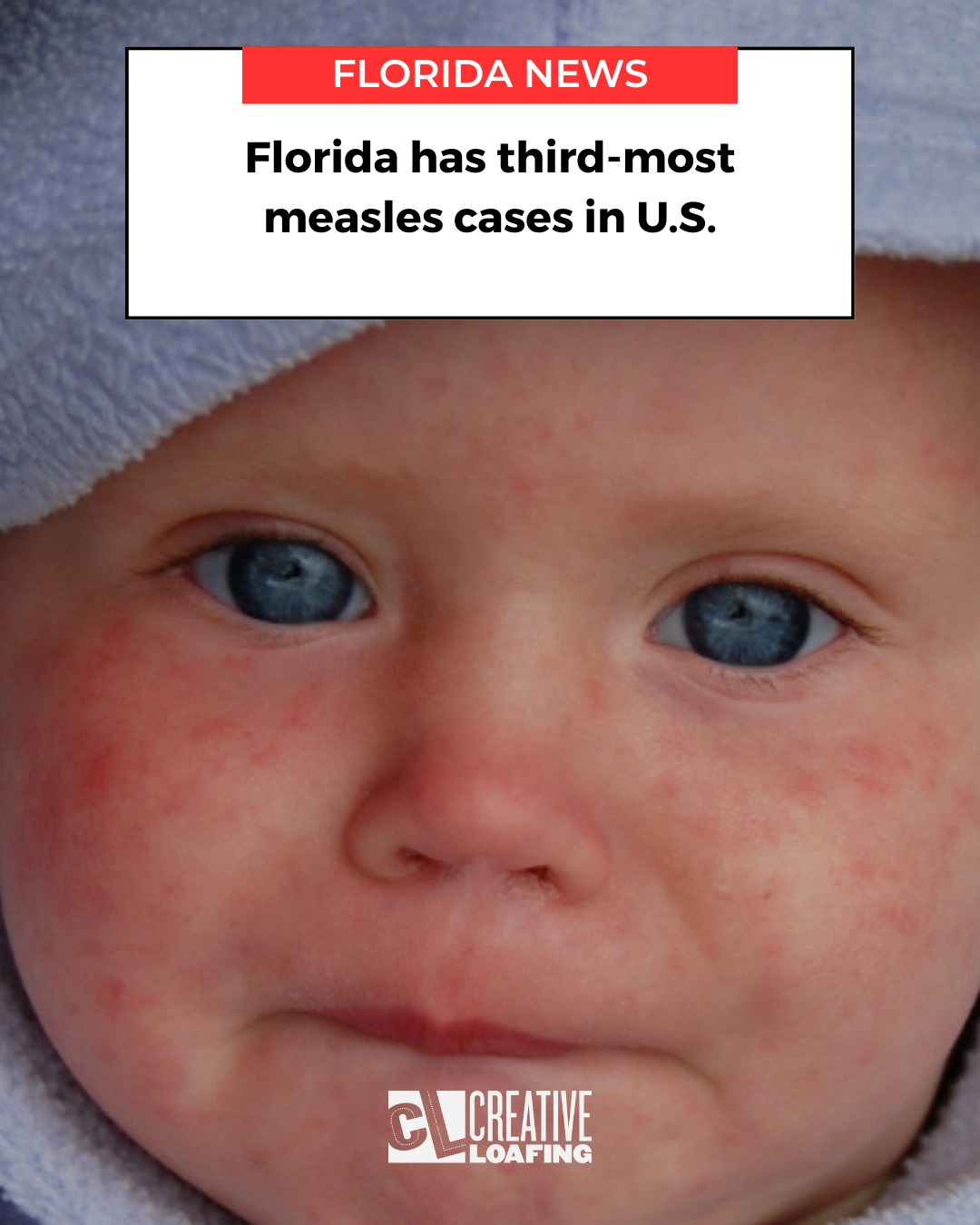 florida-has-3rd-most-measles-cases